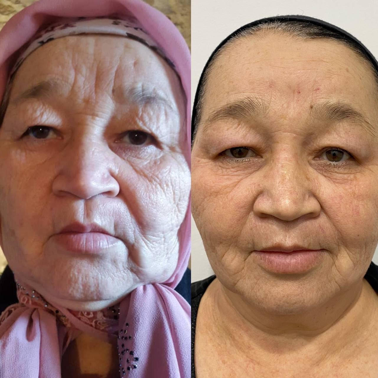 PLASMA FROID ANNABELLE