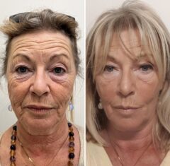 PLASMA FROID ANNABELLE